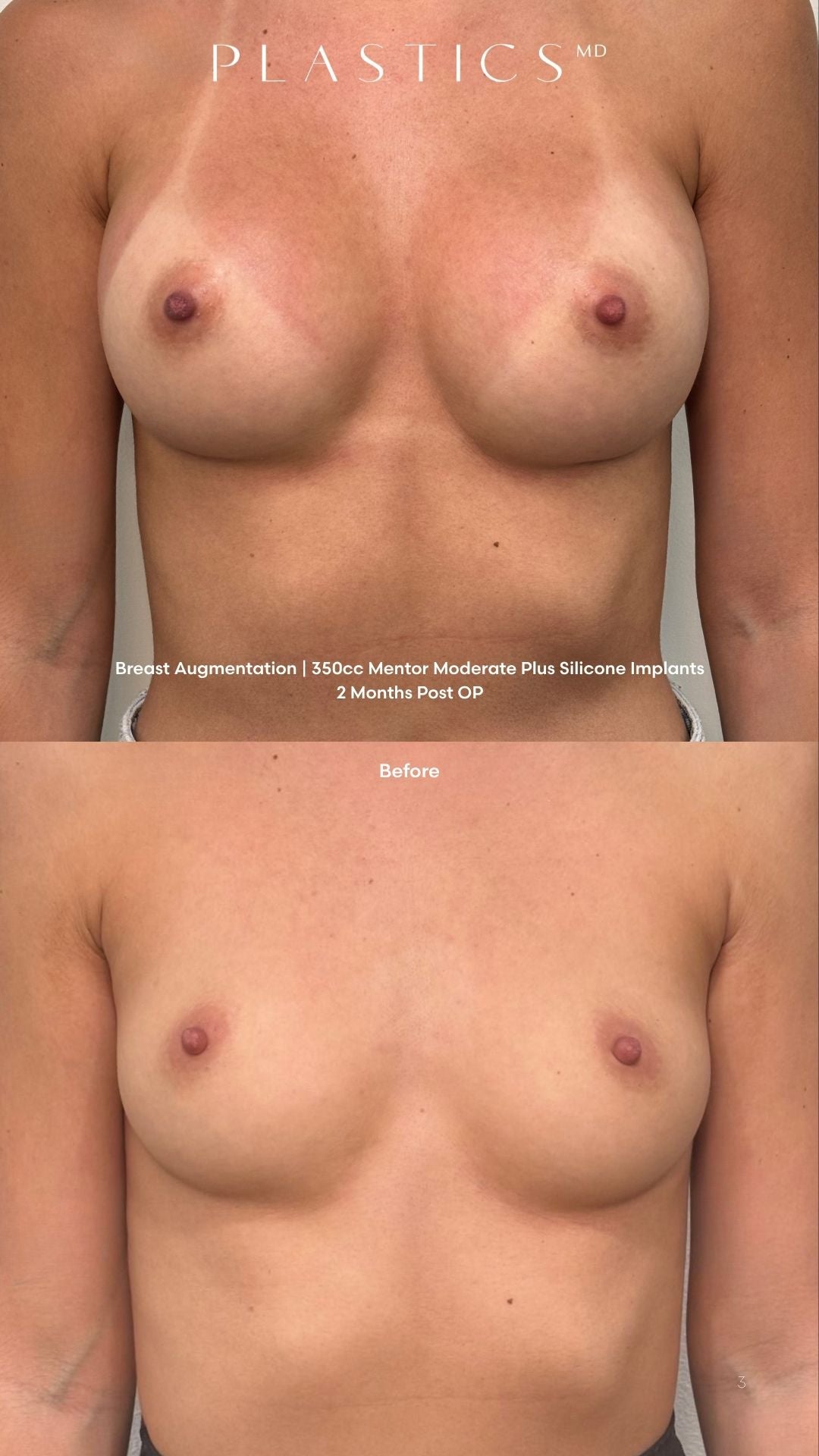 the naked breast