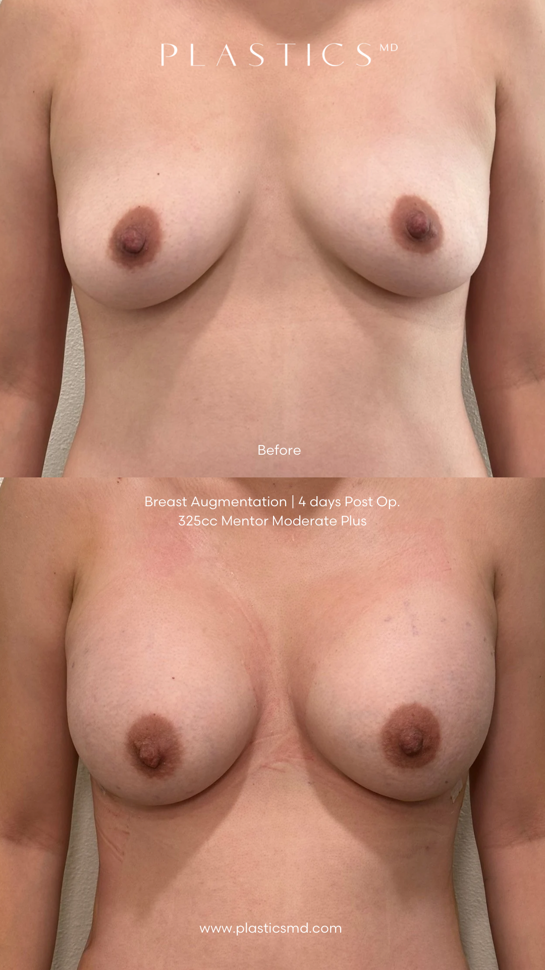 the naked breast